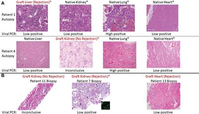 T cell repertoire profiling in allografts and native tissues in recipients with COVID–19 after solid organ transplantation: Insight into T cell–mediated allograft protection from viral infection